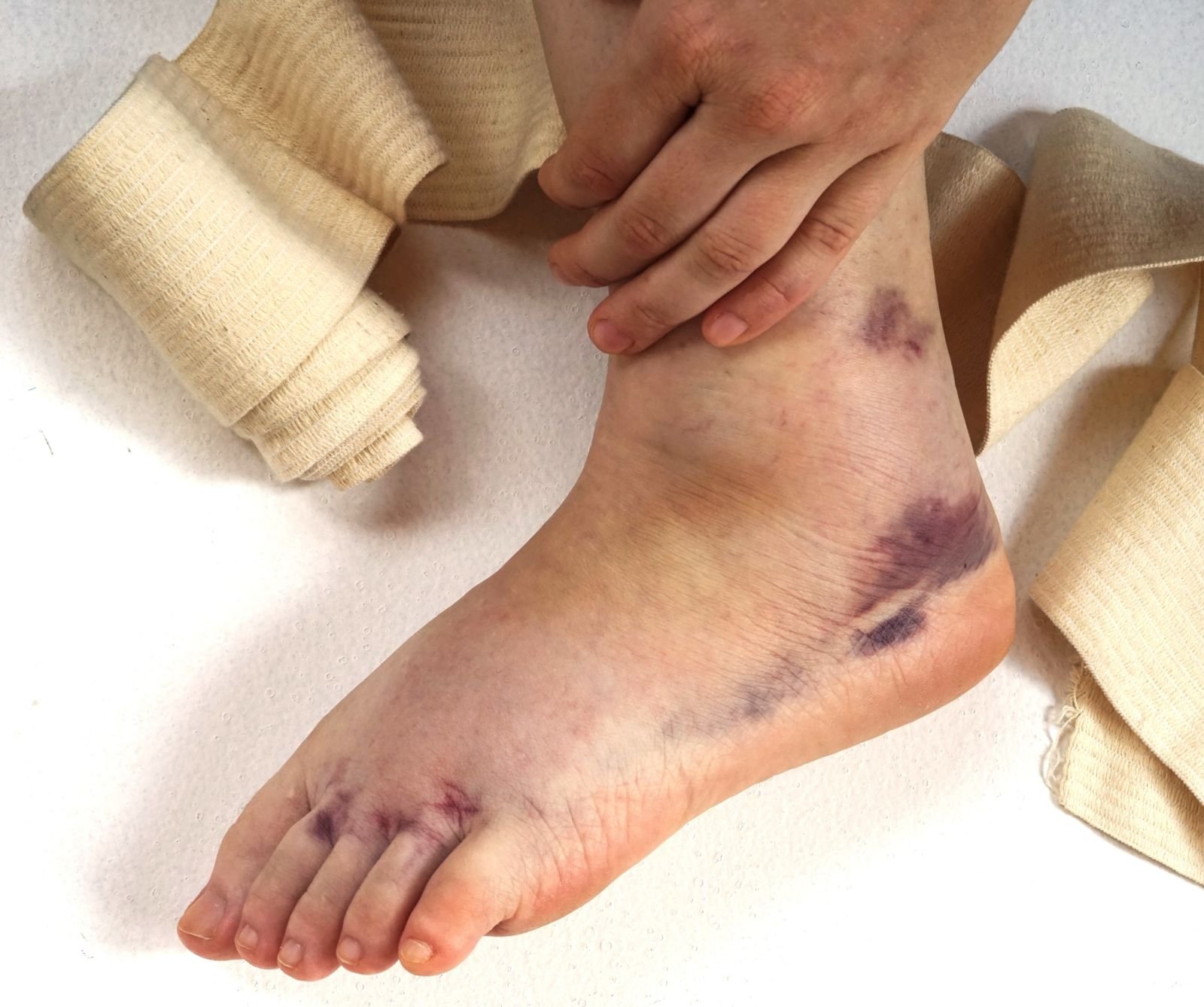 Grades of ankle sprain