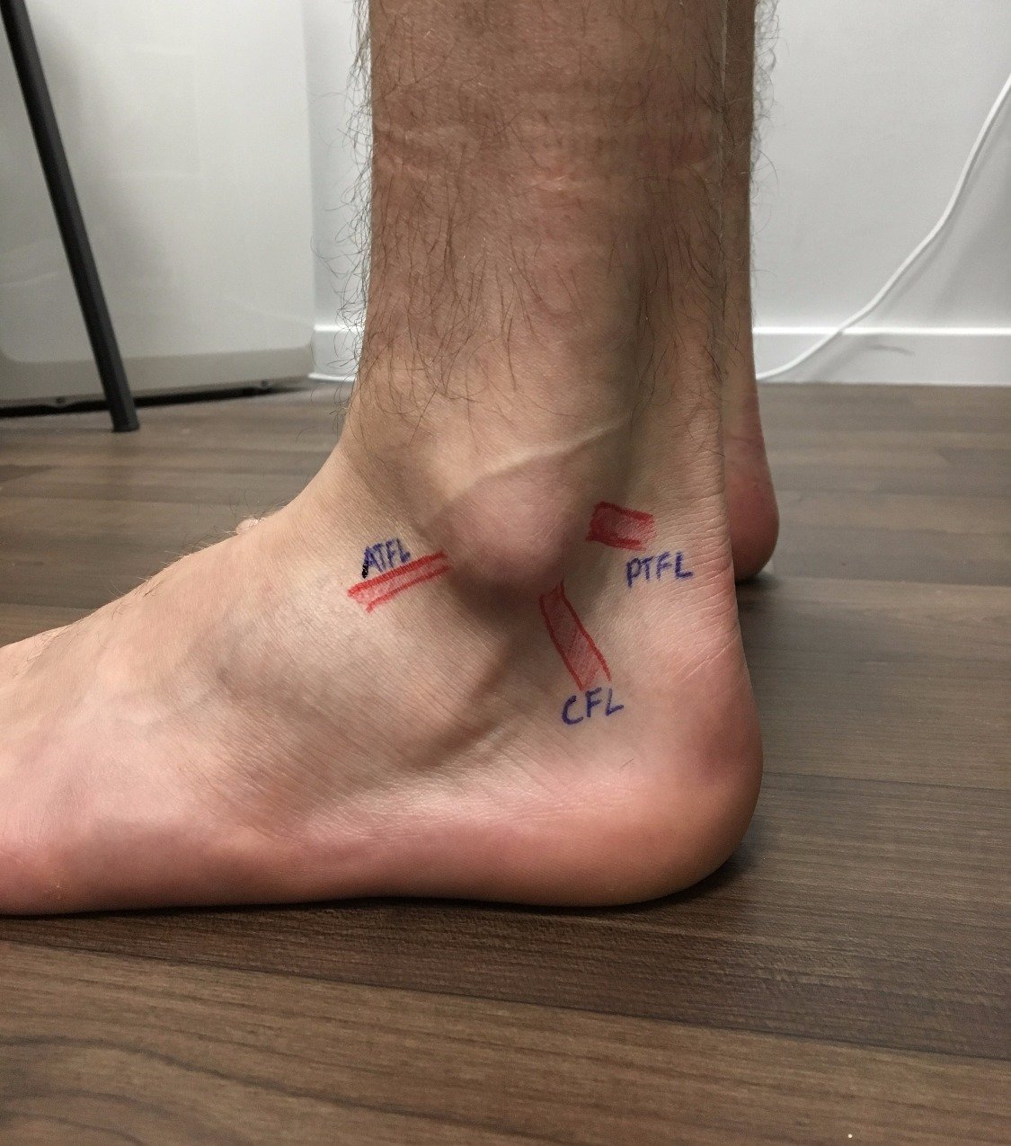 Ankle sprain ligaments
