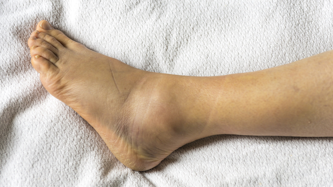 Ankle sprain signs and symptoms